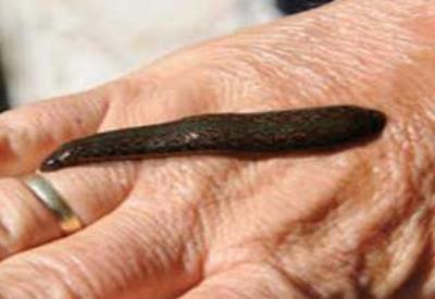Doktorların beceremediğini sülükler halletti